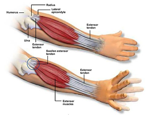 EPIKONDILITIS LATERAL (TENNIS ELBOW)